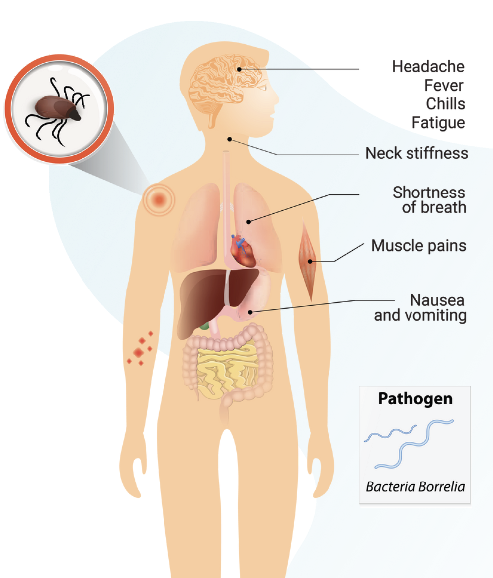 Tickborne Disease